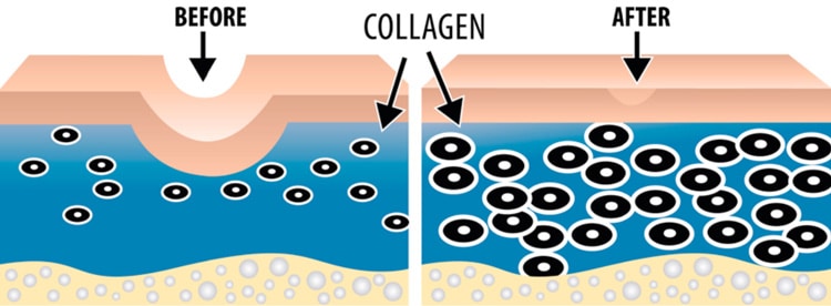 Aftercare Tips for Microneedling: Maintaining Your Results with Baskin Aesthetics in Portland, ME