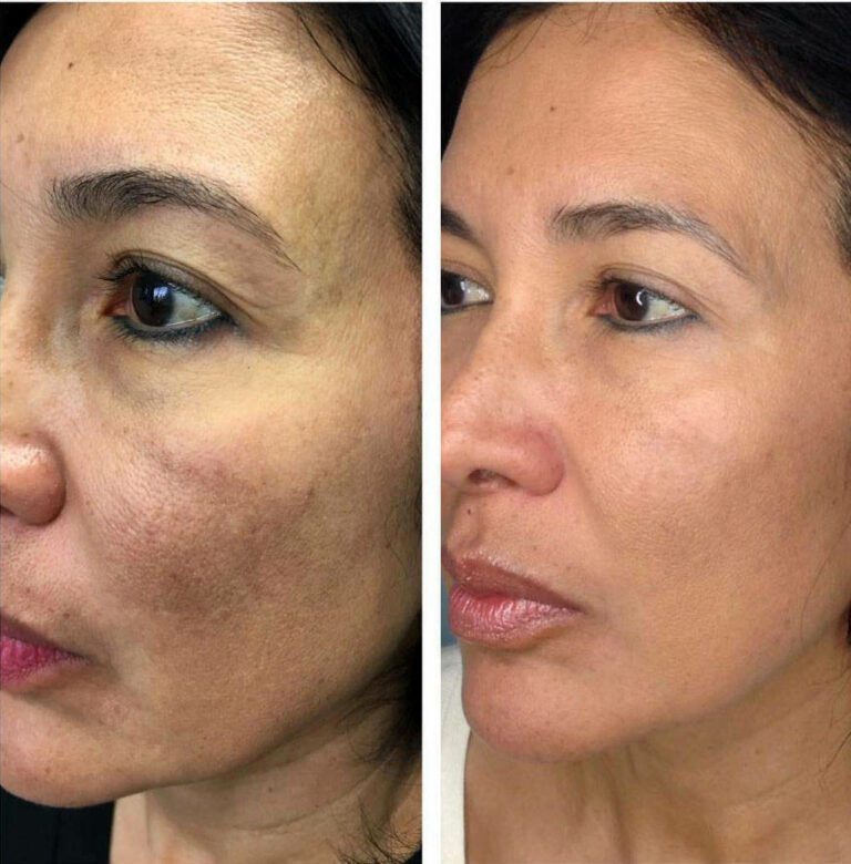 Salmon Sperm Facial Treatment
