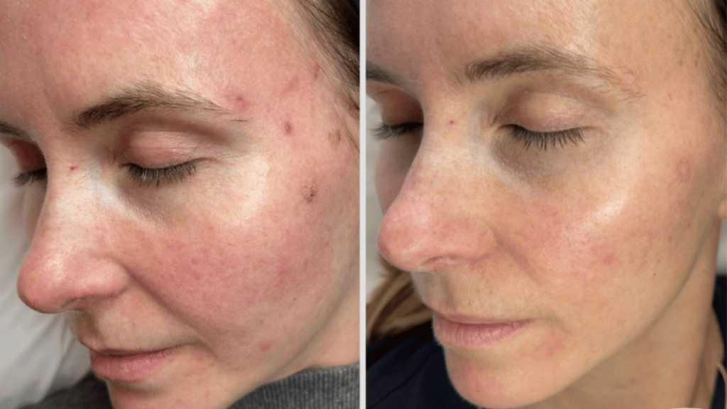 VAMP Salmon Sperm Facial Treatment