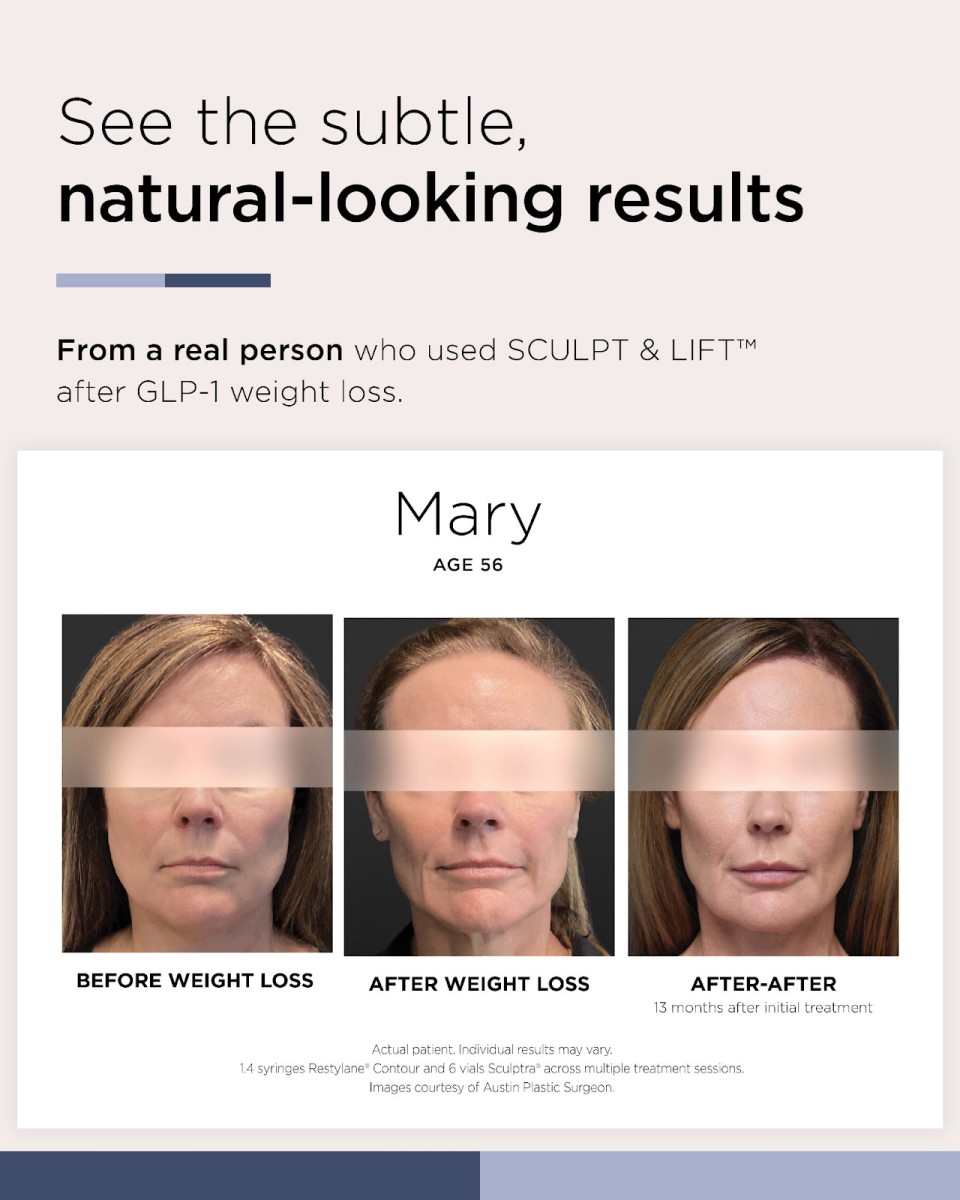 Before and after GLP-1 face treatment with facial filler Portland, ME