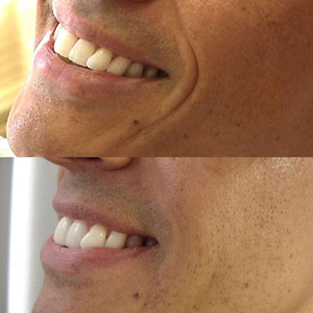Before and after results of the Fern Technique™ using hyaluronic acid filler to soften smile lines